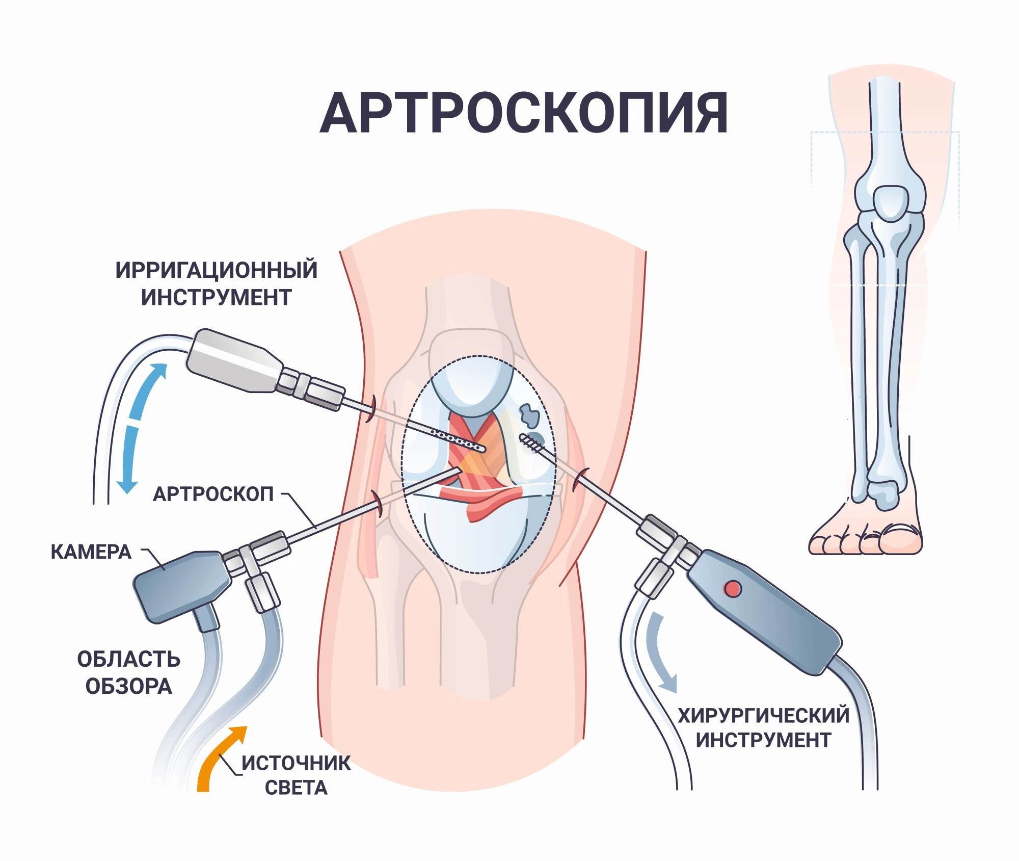 Деформирующий артроз коленного сустава – гонартроз колена - travmasport